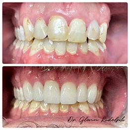 Before and after smile at Singing River Dentistry