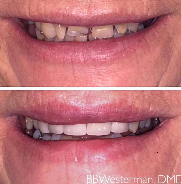 Before and after smile at Singing River Dentistry