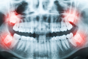 Photo of wisdom teeth xray atSinging River Dentistry in Tuscumbia, AL