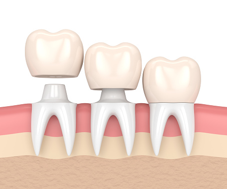 Illustration of three teeth getting porcelain crowns