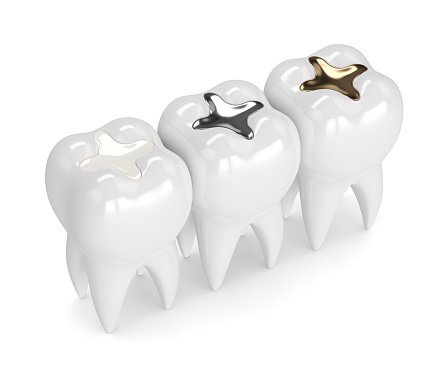 rendering of three teeth with different types of fillings available at Singing River Dentistry in Athens, AL 
