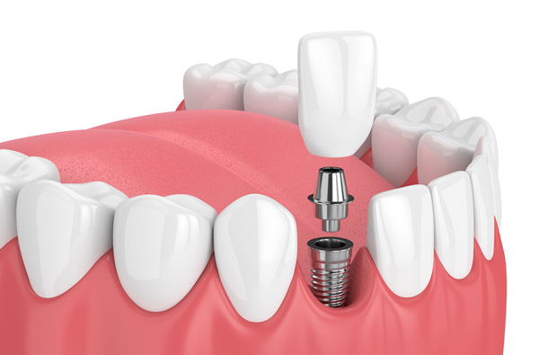Rendering of a jaw with a dental implant from Singing River Dentistry.