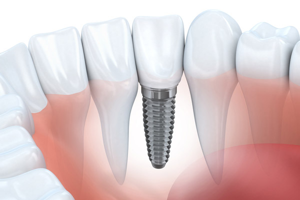 Diagram of dental implant in lower jaw provided by Singing River Dentistry in Muscle Shoals AL 35661-3286 