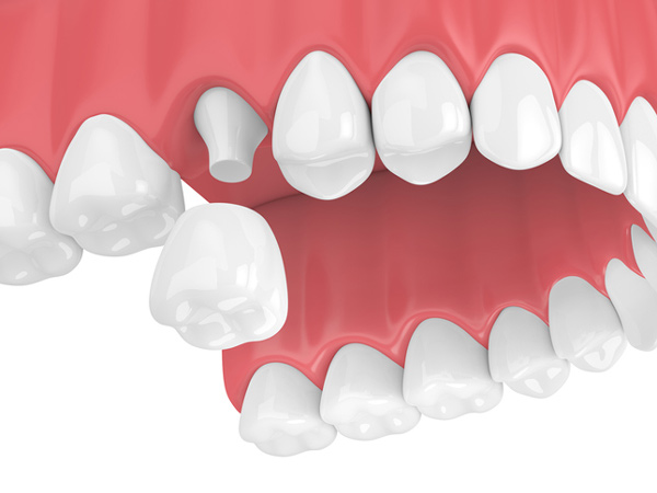 Rendering of jaw with dental crown at Singing River Dentistry
