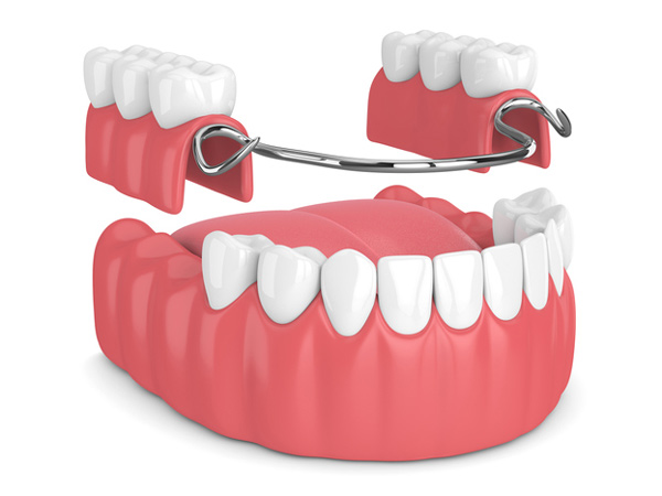 Rendering of a removable partial denture from Singing River Dentistry