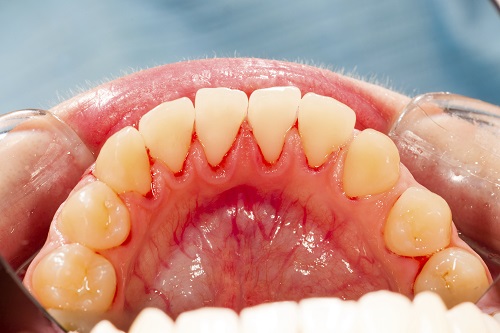 Signs You Have Developed Aggressive Periodontitis