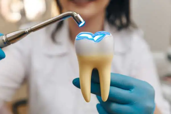 A dental model being treated with a curing light to illustrate the process of setting a filling material during restorative dental care.
